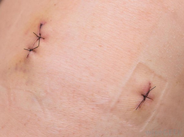 Everything you need to know about Cyst Removal Surgery
