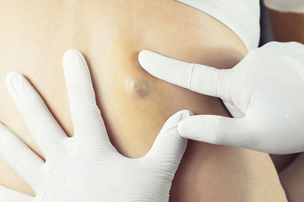 Guide to Cyst Removal Surgery and Treatment